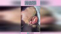 美丽都是有代价的，年纪大不想有皱纹，这医美方式是真狠！
