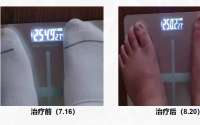 从“粪”到愈一例肠菌移植成功治疗MAFLD的案例分享